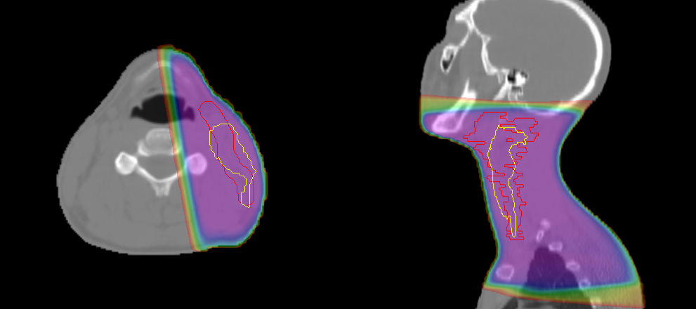 lymphoma